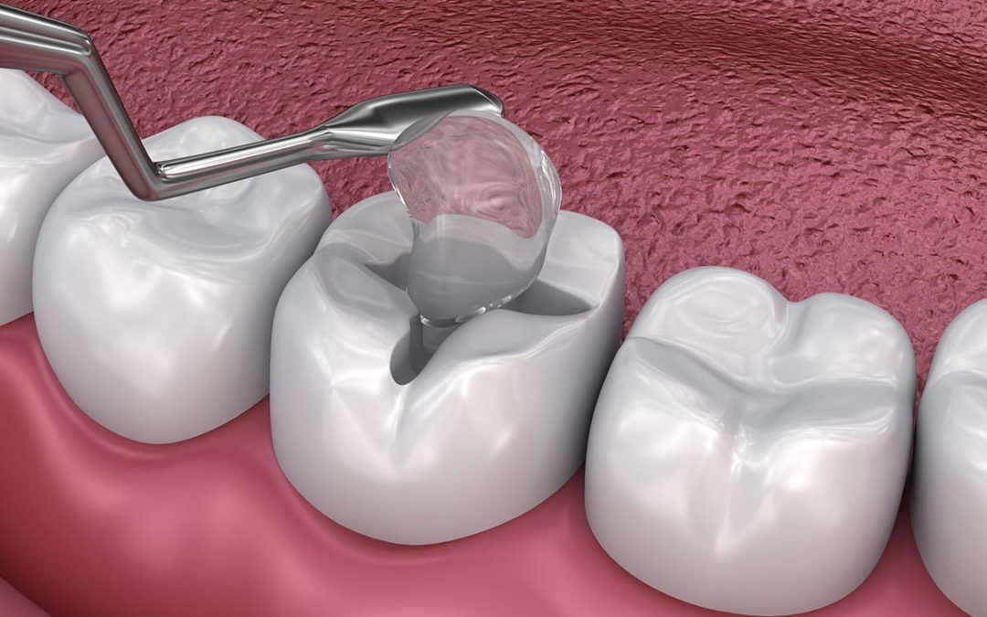 fillings case